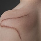 Методы лечения шрамов
