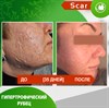 Карипаин Scar гель ферментный для кожи с Коллагеназой и Тизолем 12 мл. 3925 - фото 15133