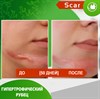Карипаин Scar гель ферментный для кожи с Коллагеназой и Тизолем 12 мл. 3925 - фото 15137