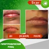 Карипаин Scar гель ферментный для кожи с Коллагеназой и Тизолем 40 мл. 3924 - фото 15143