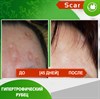 Карипаин Scar гель ферментный для кожи с Коллагеназой и Тизолем 40 мл. 3924 - фото 15148